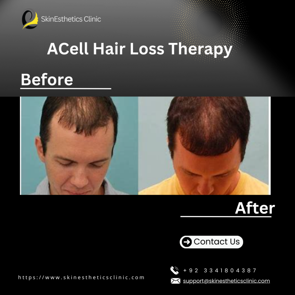 ACell Hair Loss therapy By Dr. Abbas Shah