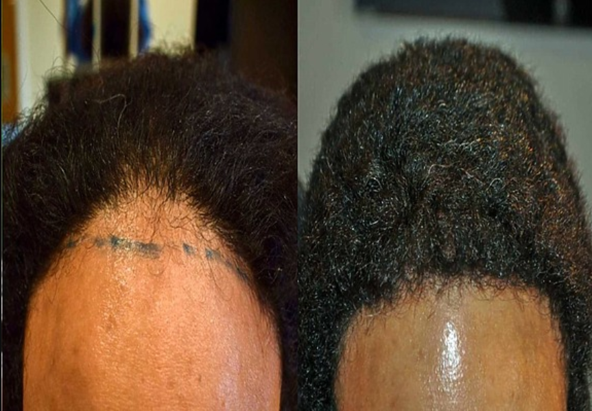 Afro Hair Transplant By Dr.Abbas Shah at SkinEsthetics Clinic Islamabad