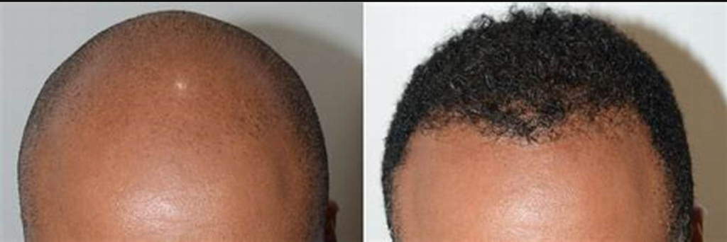 Afro Hair Transplant Skin Esthetics Dr. Abbas SHAH