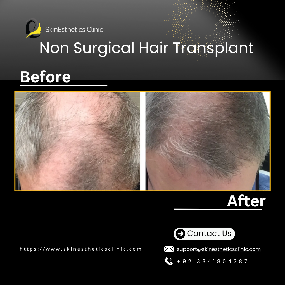 SkinEsthetics Clinic Non Surgical Hair Transplant by Dr Abbas Shah