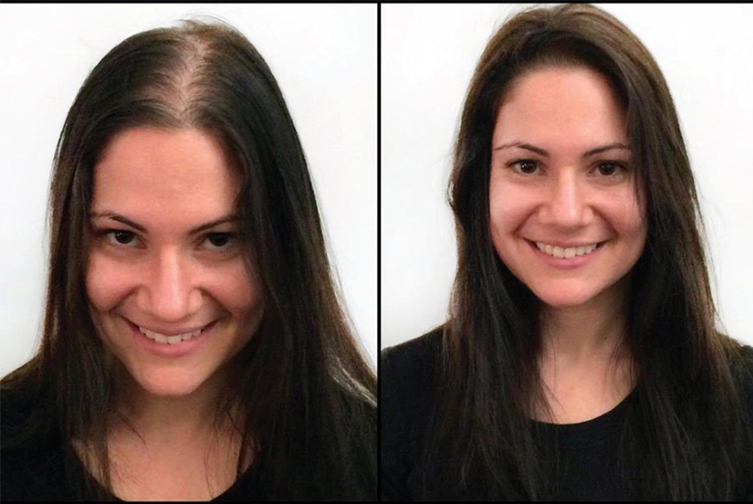 best hair loss treatment for female in Islamabad at Skin Esthetics Clinic