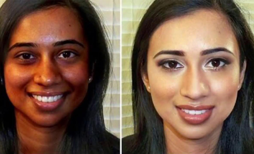 laser body whitening and glutathione skin brightening results Islamabad