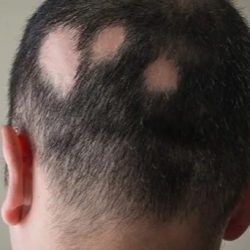 Alopecia-tratment-2