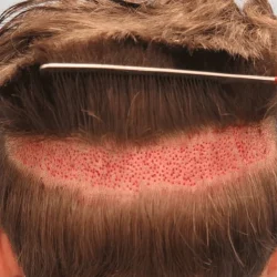 Micro implant hair-transplant